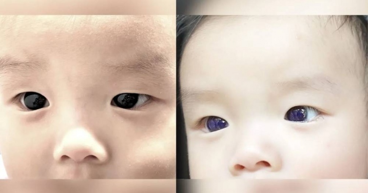 Через препарати від COVID-19 очі хлопчика у Таїланді змінили колір 