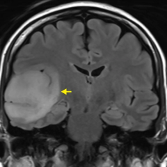 MRI brain tumor diagnosis proved to be more accurate