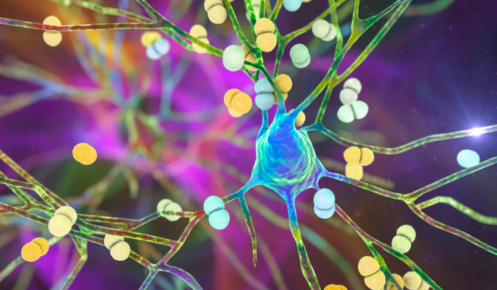 Brain cells with neurodegeneration